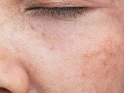 Moderne Anwendungen für filler face – Schönheit neu definiert